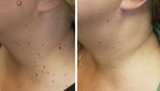  Mole Removal Los Angeles 1950 Sawtelle Blvd, Suite 138-M 