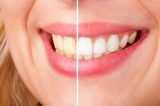Teeth Whitening Mark C. Marchbanks, D.D.S. 2624 Matlock Road Suite 100 