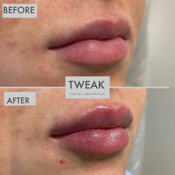  Before and Afters of TWEAK Facial Aesthetics 10 Harley Street - Photo 1 of 6