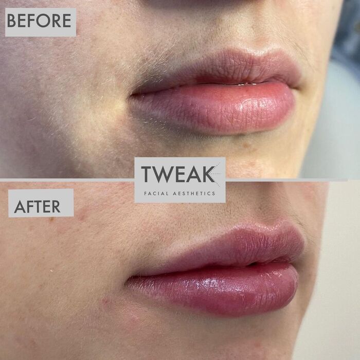  Before and Afters of TWEAK Facial Aesthetics 10 Harley Street - Photo 2 of 6