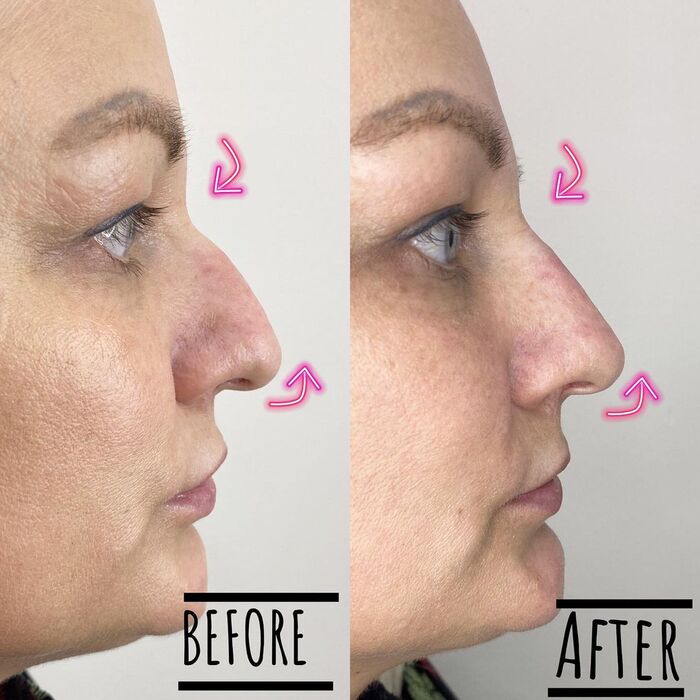  Before and Afters of TWEAK Facial Aesthetics 10 Harley Street - Photo 3 of 6