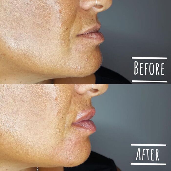  Before and Afters of TWEAK Facial Aesthetics 10 Harley Street - Photo 4 of 6