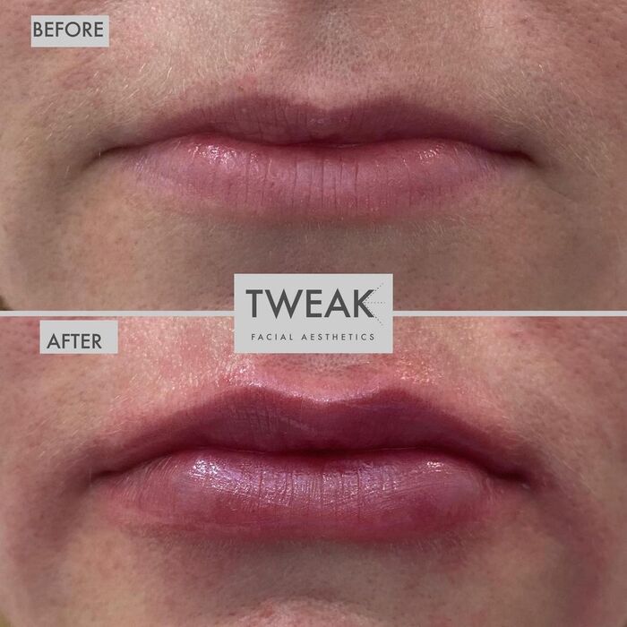  Before and Afters of TWEAK Facial Aesthetics 10 Harley Street - Photo 5 of 6