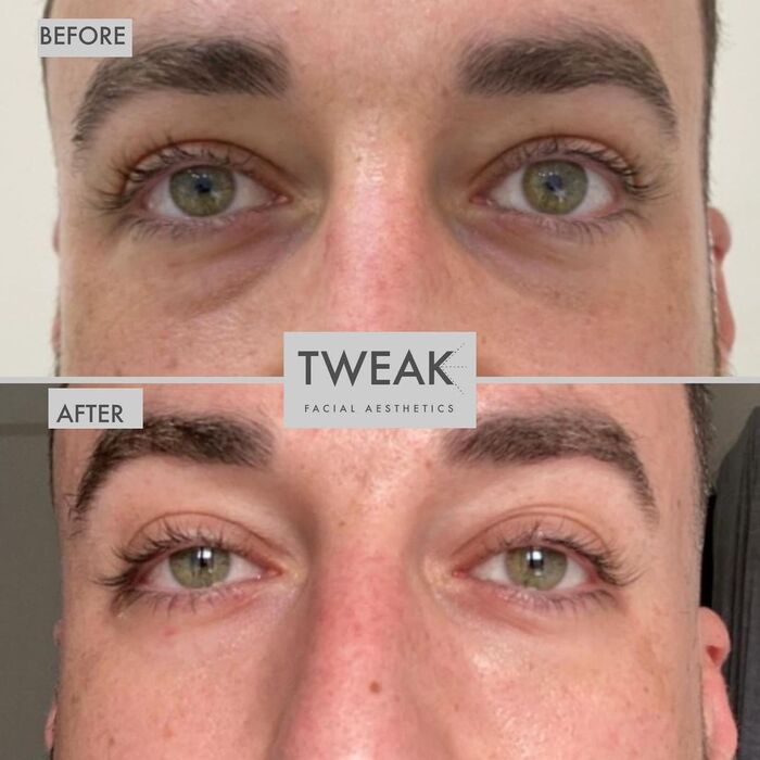 Before and Afters of TWEAK Facial Aesthetics 10 Harley Street - Photo 6 of 6