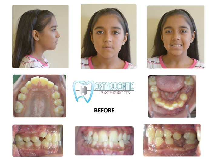 before and after braces Orthodontic Experts West of Orthodontic Experts West 4709 N Harlem Ave - Photo 2 of 9