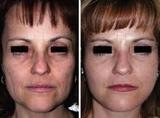 Lipofilling Surgery in Mumbai, Mumbai