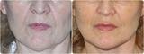 Lipofilling Surgery in Mumbai, Mumbai