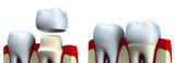 Dental Crowns, Brooklyn