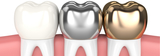 Dental Crowns, Brooklyn
