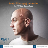New Album of Scalp Micropigmentation India