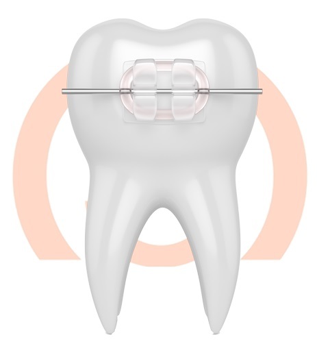 Ceramic braces are made of clear materials and are therefore less visible on your teeth than metal braces.<br />
Profile Photos of Schroeder Orthodontics 650 E. Southlake Blvd - Photo 2 of 5 Ceramic braces are made of clear materials and are therefore less visible on your teeth than metal braces.<br />
Profile Photos of Schroeder Orthodontics 650 E. Southlake Blvd - Photo 2 of 5