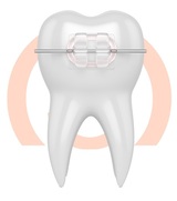 Ceramic braces are made of clear materials and are therefore less visible on your teeth than metal braces.
, Schroeder Orthodontics, Southlake