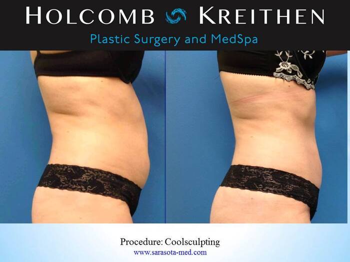  New Album of Holcomb - Kreithen Plastic Surgery & MedSpa 1 S. School Ave, Ste 800 - Photo 2 of 4