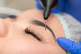 Fibroblast Plasma Pens San Jose, San Jose