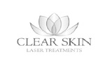 Clear skin laser treatments, Rochester