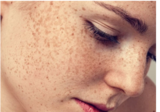 Microneedling NZ, Christchurch
