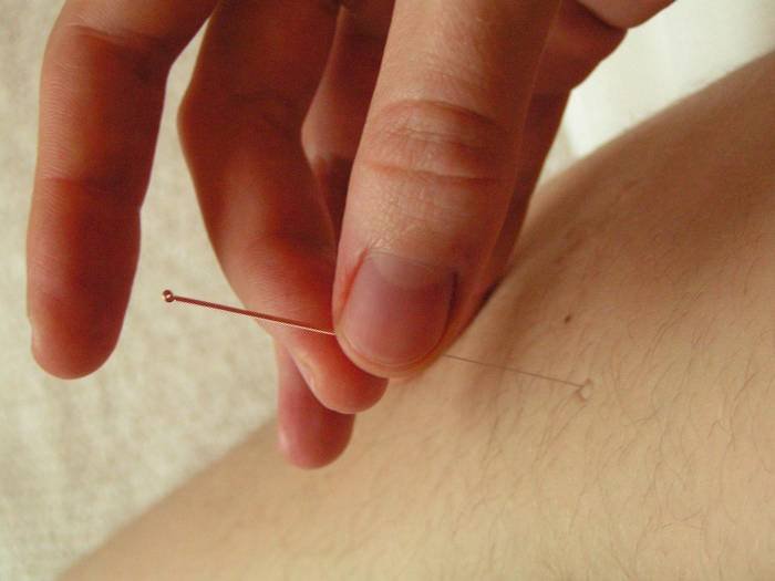 hair-thin sterile needles are inserted into acupuncture points to regulate the flow of energy in the body Profile Photos of Acupuncture & Herbal Medicine, London N8 Raleigh Road - Photo 2 of 4