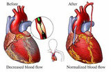 Best Heart Surgery in India at ABMH Hospital, Pune