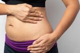 Treatment for Birthmarks, Dubai