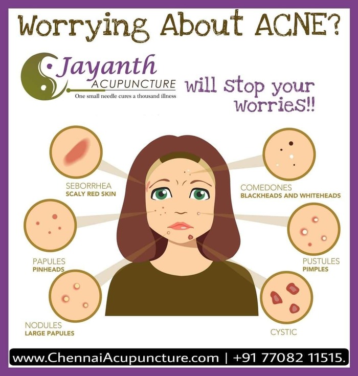 Acupuncture Treatment for Acne / Pimples in Chennai - Acupuncture Near Me Acupuncture Treatment of Chennai Jayanth Acupuncture Clinic #77, Harrington Road, Chetpet - Photo 23 of 42 Acupuncture Treatment for Acne / Pimples in Chennai - Acupuncture Near Me Acupuncture Treatment of Chennai Jayanth Acupuncture Clinic #77, Harrington Road, Chetpet - Photo 23 of 42