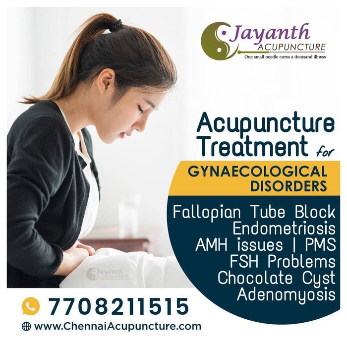 Acupuncture Treatment for Gynecological Disorders in Chennai. Acupuncture Treatment of Chennai Jayanth Acupuncture Clinic #77, Harrington Road, Chetpet - Photo 12 of 42 Acupuncture Treatment for Gynecological Disorders in Chennai. Acupuncture Treatment of Chennai Jayanth Acupuncture Clinic #77, Harrington Road, Chetpet - Photo 12 of 42