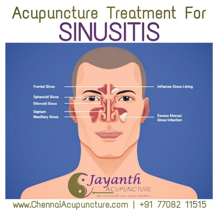 Acupuncture Treatment For Sinusitis in Chennai  Acupuncture Treatment of Chennai Jayanth Acupuncture Clinic #77, Harrington Road, Chetpet - Photo 4 of 42
