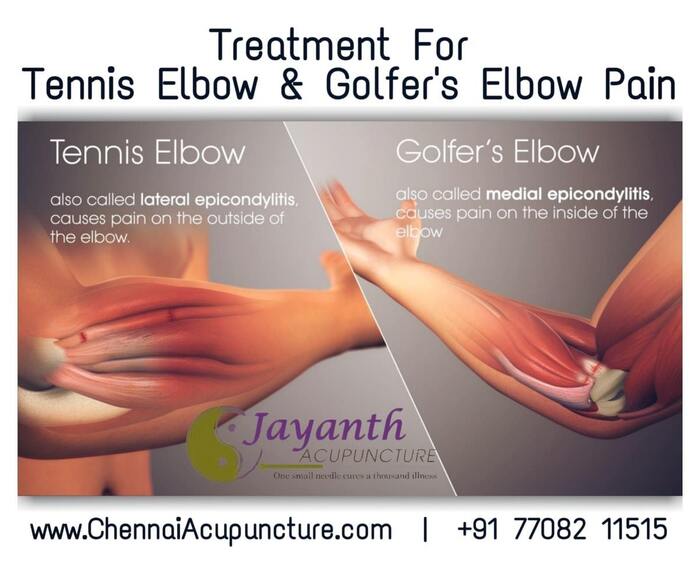 Acupuncture Treatment For Tennis Elbow and Golfer's Elbow pin in Chennai Acupuncture Treatment of Chennai Jayanth Acupuncture Clinic #77, Harrington Road, Chetpet - Photo 15 of 42 Acupuncture Treatment For Tennis Elbow and Golfer's Elbow pin in Chennai Acupuncture Treatment of Chennai Jayanth Acupuncture Clinic #77, Harrington Road, Chetpet - Photo 15 of 42