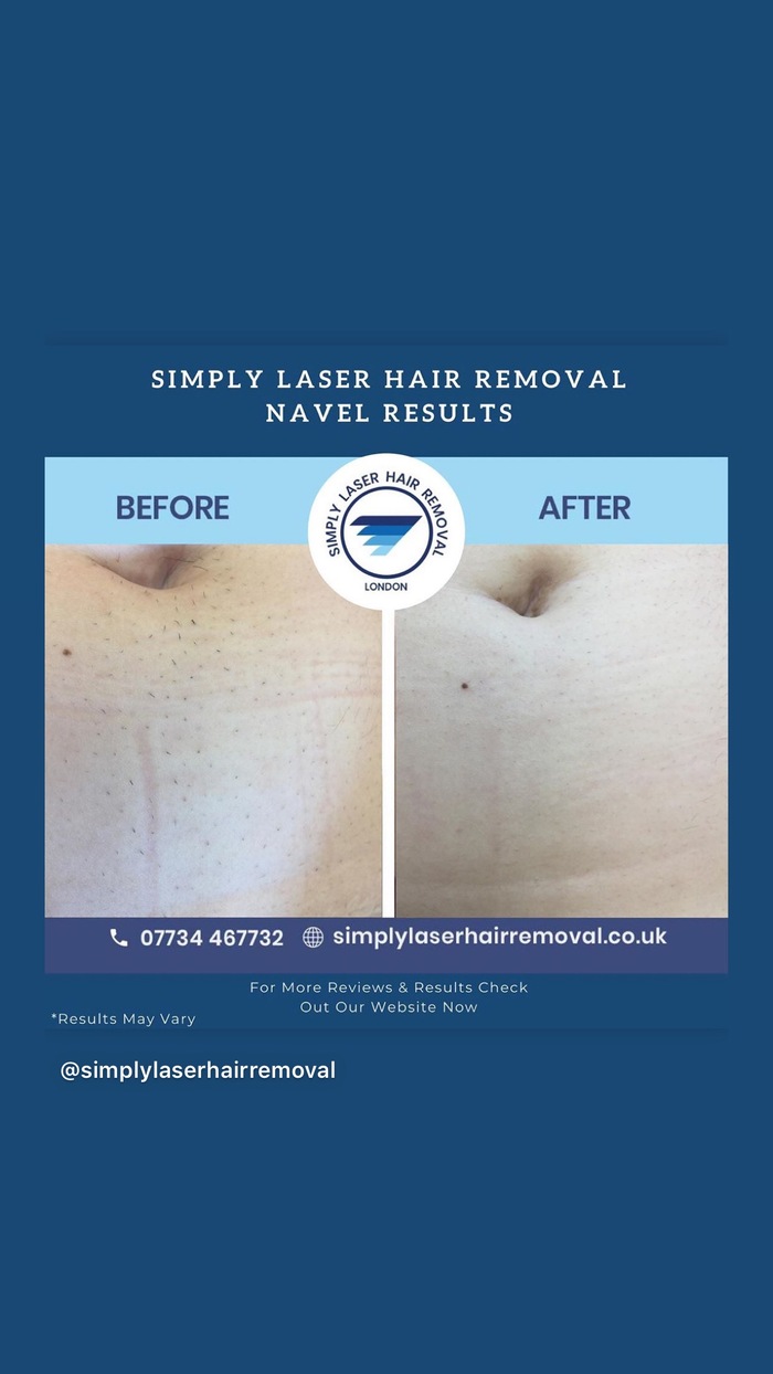  Profile Photos of Simply Laser Hair Removal & Skin Clinic 4 Streatham Street. - Photo 4 of 5
