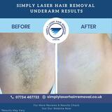 Simply Laser Hair Removal & Skin Clinic, London