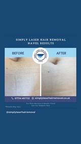 Simply Laser Hair Removal & Skin Clinic, London