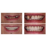 Full Mouth Dental Implants Turkey, London