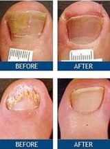 Laser Nail Therapy - Largest Toenail Fungus Treatment Center, Los Angeles