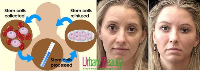  Cosmetic Surgery Thailand Services of Urban Beauty Thailand - Cosmetic Surgery Thailand Fat Removal Bangkok ambassador hotel bangkok sukhumvit soi11 - Photo 10 of 11