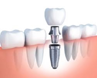 A cross section picture of a dental implant<br />
 New Album of Dentistry at The Grove 2142 Mountain Grove Ave - Photo 3 of 11