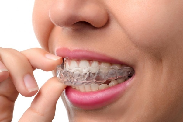 A close-up shot of a patient placing their invisalign braces within their mouth<br />
New Album of Dentistry at The Grove 2142 Mountain Grove Ave - Photo 5 of 11 A close-up shot of a patient placing their invisalign braces within their mouth<br />
New Album of Dentistry at The Grove 2142 Mountain Grove Ave - Photo 5 of 11