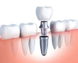 A cross section picture of a dental implant<br />
 Dentistry at The Grove 2142 Mountain Grove Ave 