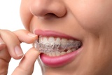 A close-up shot of a patient placing their invisalign braces within their mouth<br />
 Dentistry at The Grove 2142 Mountain Grove Ave 