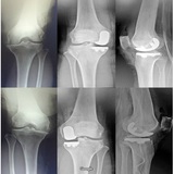 Robotic Joint Center: Frederick Buechel, Jr. MD, New York