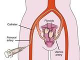  USA FIbroid Centers 864 Pennsylvania Ave 