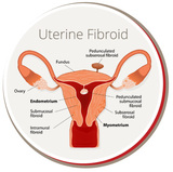  USA FIbroid Centers 864 Pennsylvania Ave 