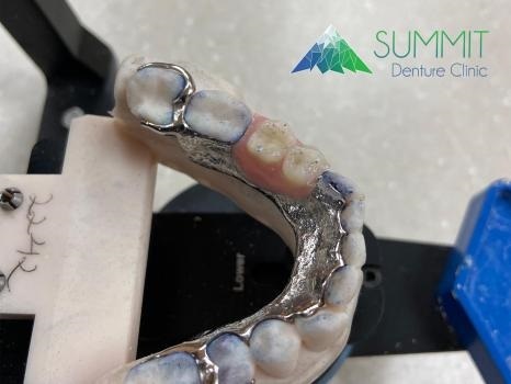  Profile Photos of Summit Denture Clinic 2881 Garden Street, #130 - Photo 2 of 4