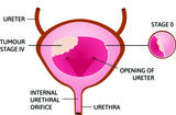 Prostate Ultrasound And Biopsy, Brooklyn