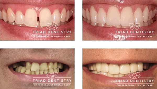  New Album of Triad Dentistry | Dental Implants Greensboro NC 2516 - A, Oakcrest Ave - Photo 3 of 3