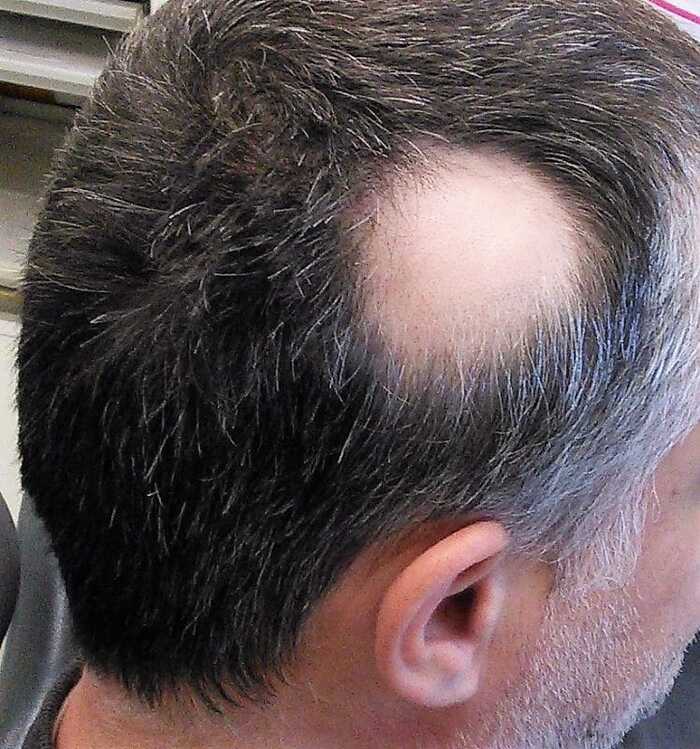 Profile Photos of Scalp Micro Pigmentation by Skulltec Room 203, Mirren Court One, 119 Renfrew Road - Photo 2 of 6