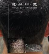 Scalp Micro Pigmentation by Skulltec, Paisley
