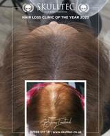 Scalp Micro Pigmentation by Skulltec, Paisley