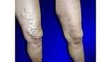 USA Vein Clinics, Tamarac