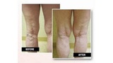 USA Vein Clinics, Tamarac