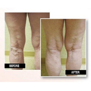  New Album of USA Vein Clinics 1500 Cornerside Blvd, Ste 300 - Photo 1 of 3