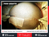 Profile Photos of Camilia Clinic Hair Transplant in Turkey
